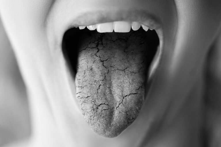 Why Do I Have a Dry Mouth and How Is It Treated?